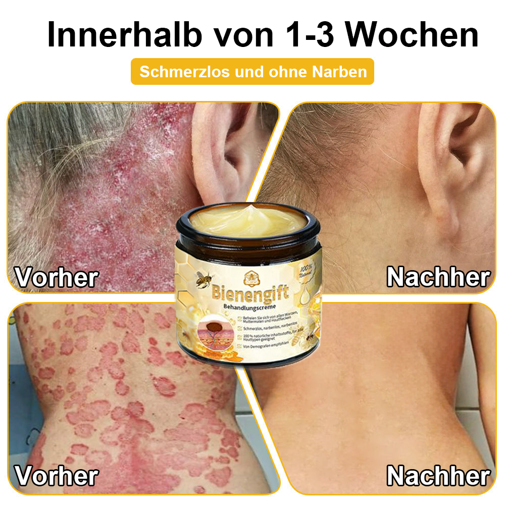 [Offizieller Laden] TLOPA® Fortgeschrittene Bienengift Behandlungscreme  (🔥Letzter Tag Aktion 80% Rabatt)