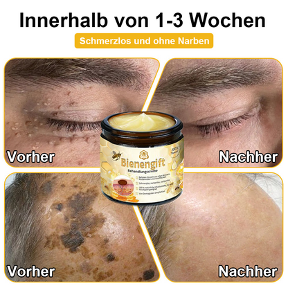 [Offizieller Laden] TLOPA® Fortgeschrittene Bienengift Behandlungscreme  (🔥Letzter Tag Aktion 80% Rabatt)