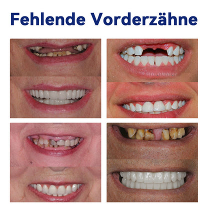 Bikenda™ Silikon-Zahnprothesen-Reline-Set (ADA-zertifiziert) 🍀