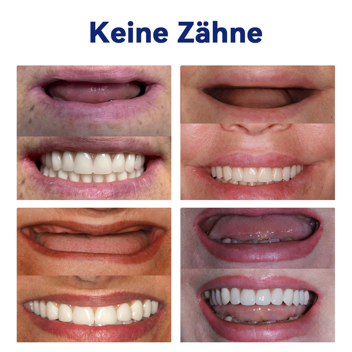 Bikenda™ Silikon-Zahnprothesen-Reline-Set (ADA-zertifiziert) 🍀