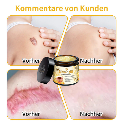 [Offizieller Laden] TLOPA® Fortgeschrittene Bienengift Behandlungscreme  (🔥Letzter Tag Aktion 80% Rabatt)